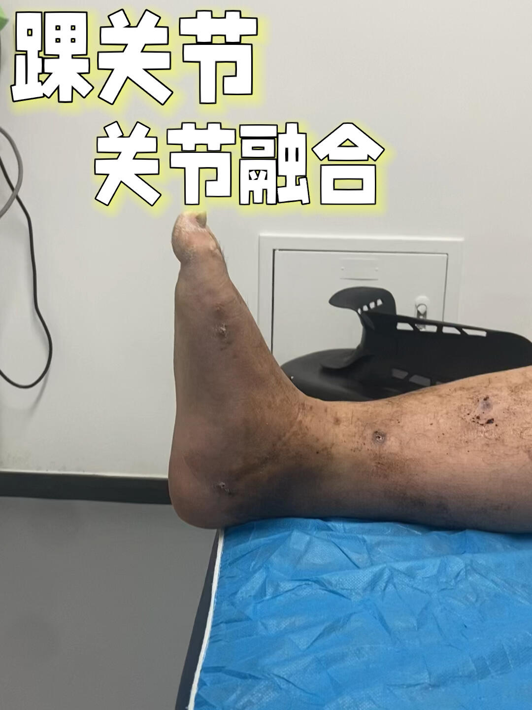 华体会官网app-球员脚踝伤势大幅缩短康复时间，备战重要比赛的简单介绍